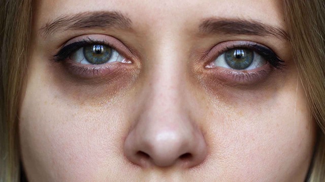 চোখের নিচে কালো দাগ পড়া কি লিভারের সমস্যার ইঙ্গিত দেয়?