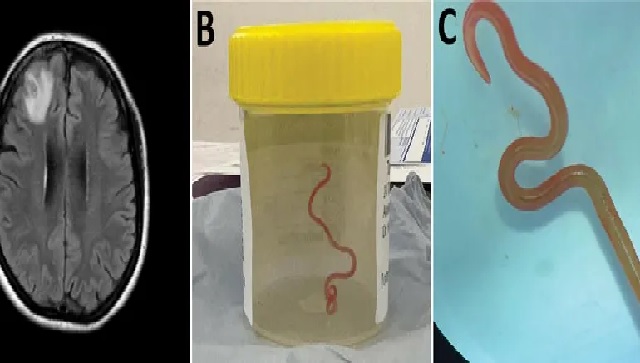 অবিশ্বাস্য: জীবন্ত কৃমি বের করা হলো নারীর ব্রেন থেকে