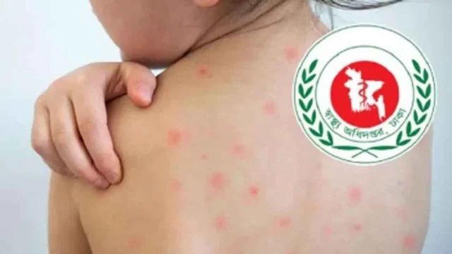 হাম ও উপসর্গে আরো ৩ শিশুর মৃত্যু, আক্রান্ত ১১৭০