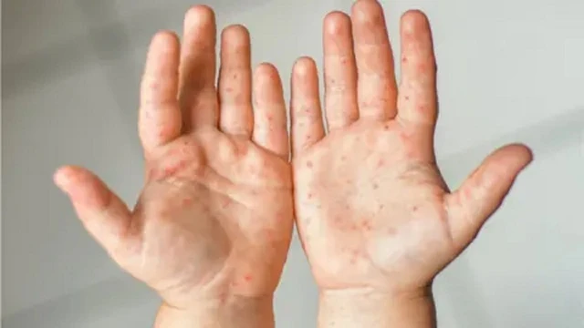 হাম উপসর্গে আরও ৪ শিশুর মৃত্যু